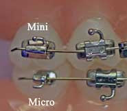 Micro - UL 2nd Molar Bracket