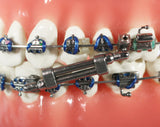 Twin Force® Bite Corrector Device - Double Lock