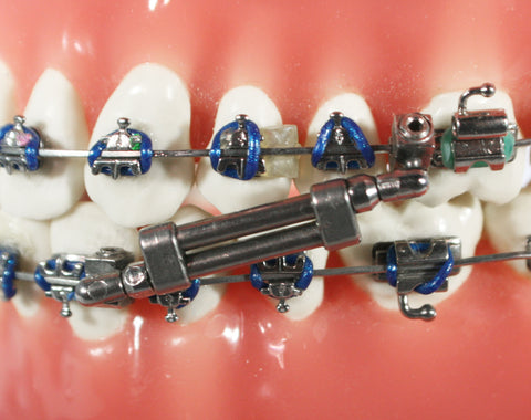 Twin Force® Bite Corrector Device - Double Lock