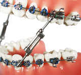 Twin Force® Bite Corrector Device - Double Lock